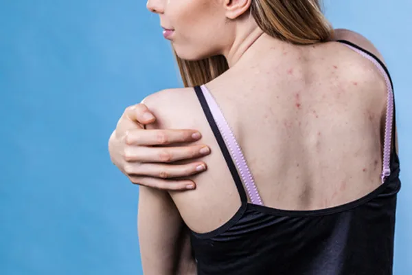 Problem pryszczy na plecach u młodej kobiety